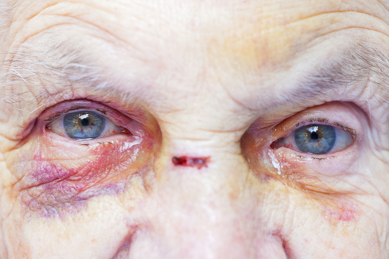 Injured elderly woman